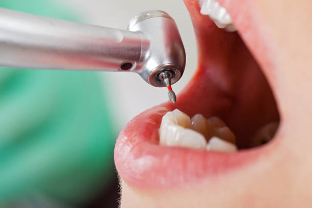Best Emergency Treatment for Dental Infections or Abscesses in Stafford, TX